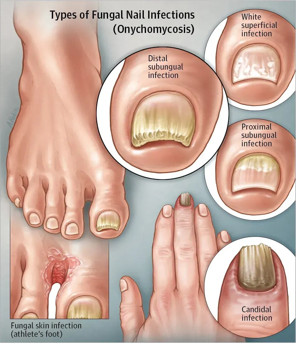 Exofeet oil u ljekarnama - narudžba - gdje kupiti - Hrvatska - cijena - recenzije - rezultati - iskustva - sastav.